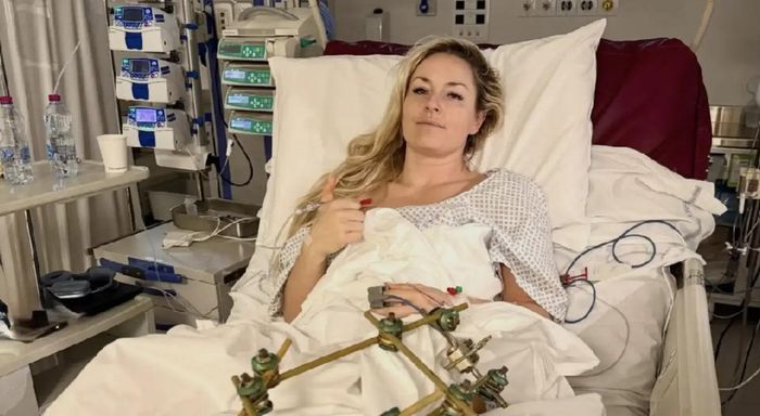 Легендарна лижниця Вонн вперше показала свій стан після страшного падіння на Олімпіаді 2026 і трьох операцій (ФОТО)